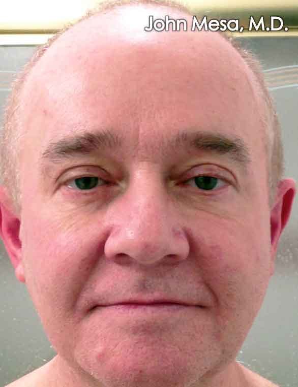 Botox Before & After Gallery - Patient 6371644 - Image 2