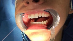 a photo of the inside of someone mouth during operation