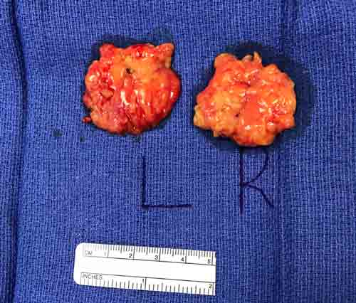 Buccal fat