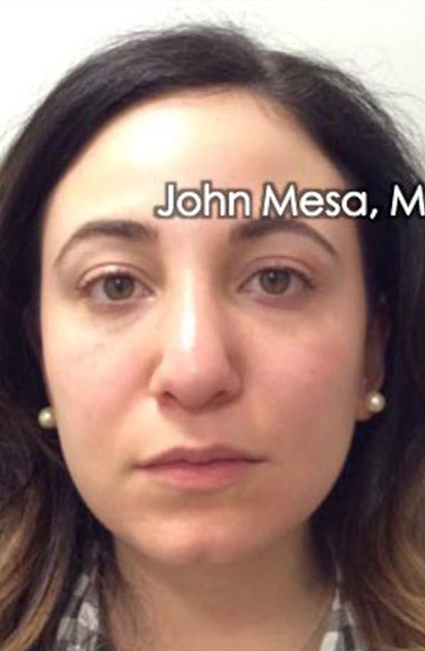 Buccal Fat Pad Removal Before & After Gallery - Patient 13823388 - Image 1