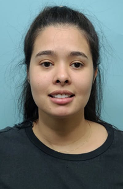 Buccal Fat Pad Removal Before & After Gallery - Patient 13842357 - Image 2