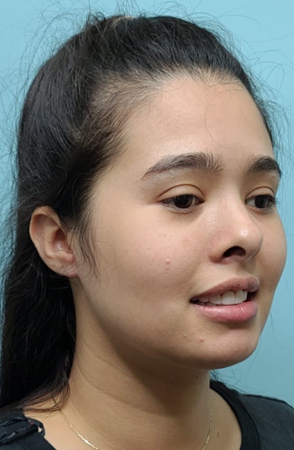 Before and after buccal fat removal in Miami with Dr. Mesa