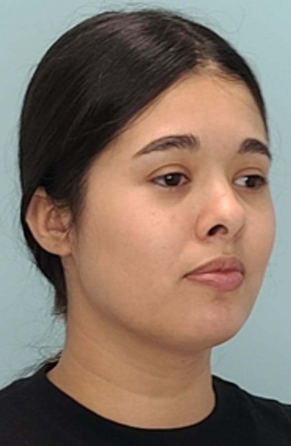 Before and after buccal fat removal in Miami with Dr. Mesa