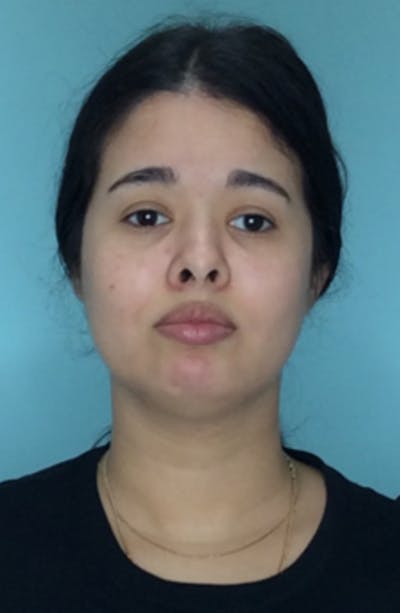 Buccal Fat Pad Removal Before & After Gallery - Patient 13842357 - Image 1