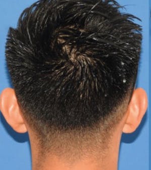 Otoplasty