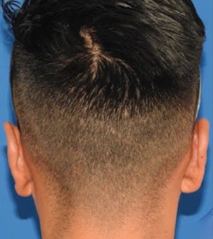 Otoplasty
