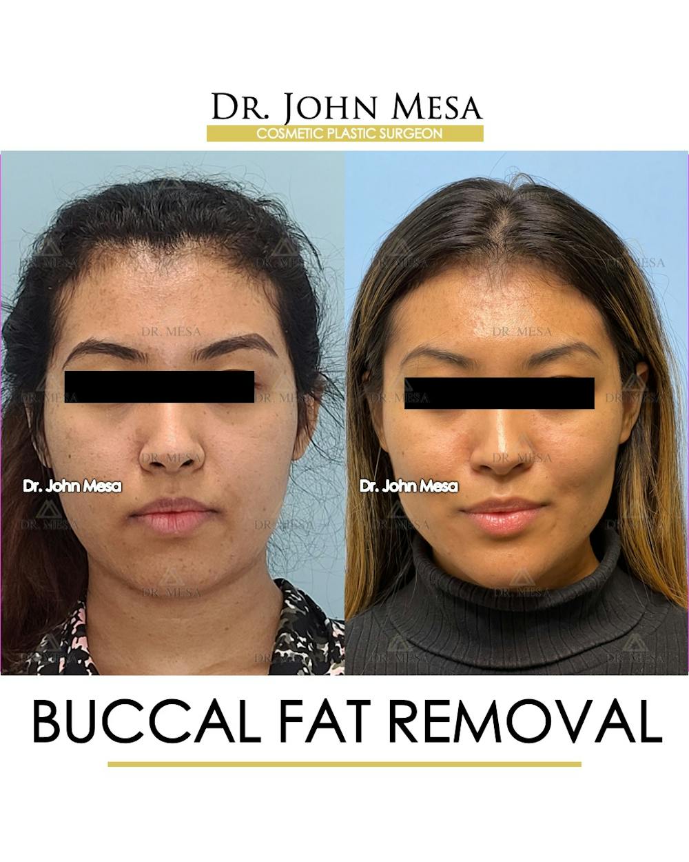 Buccal Fat Pad Removal Before & After Gallery - Patient 148316698 - Image 1