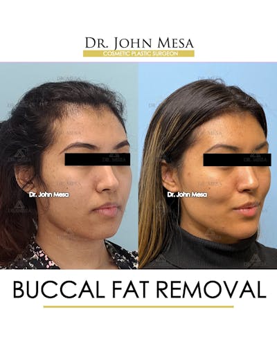 Buccal Fat Pad Removal Before & After Gallery - Patient 148316698 - Image 2