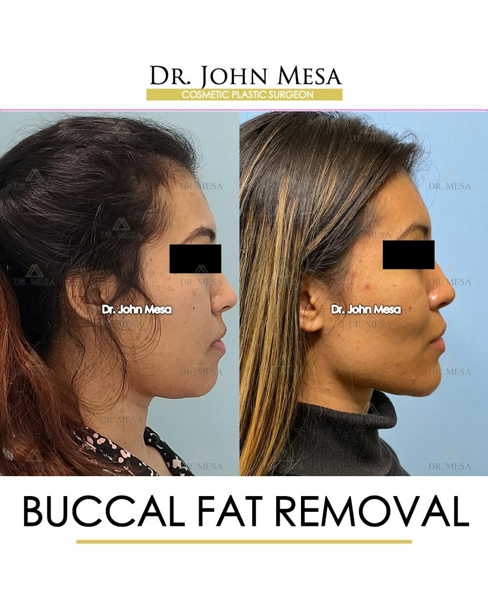 Buccal Fat Pad Removal Before & After Gallery - Patient 148316698 - Image 3