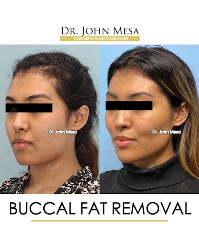 Buccal Fat Pad Removal Before & After Gallery - Patient 148316698 - Image 4