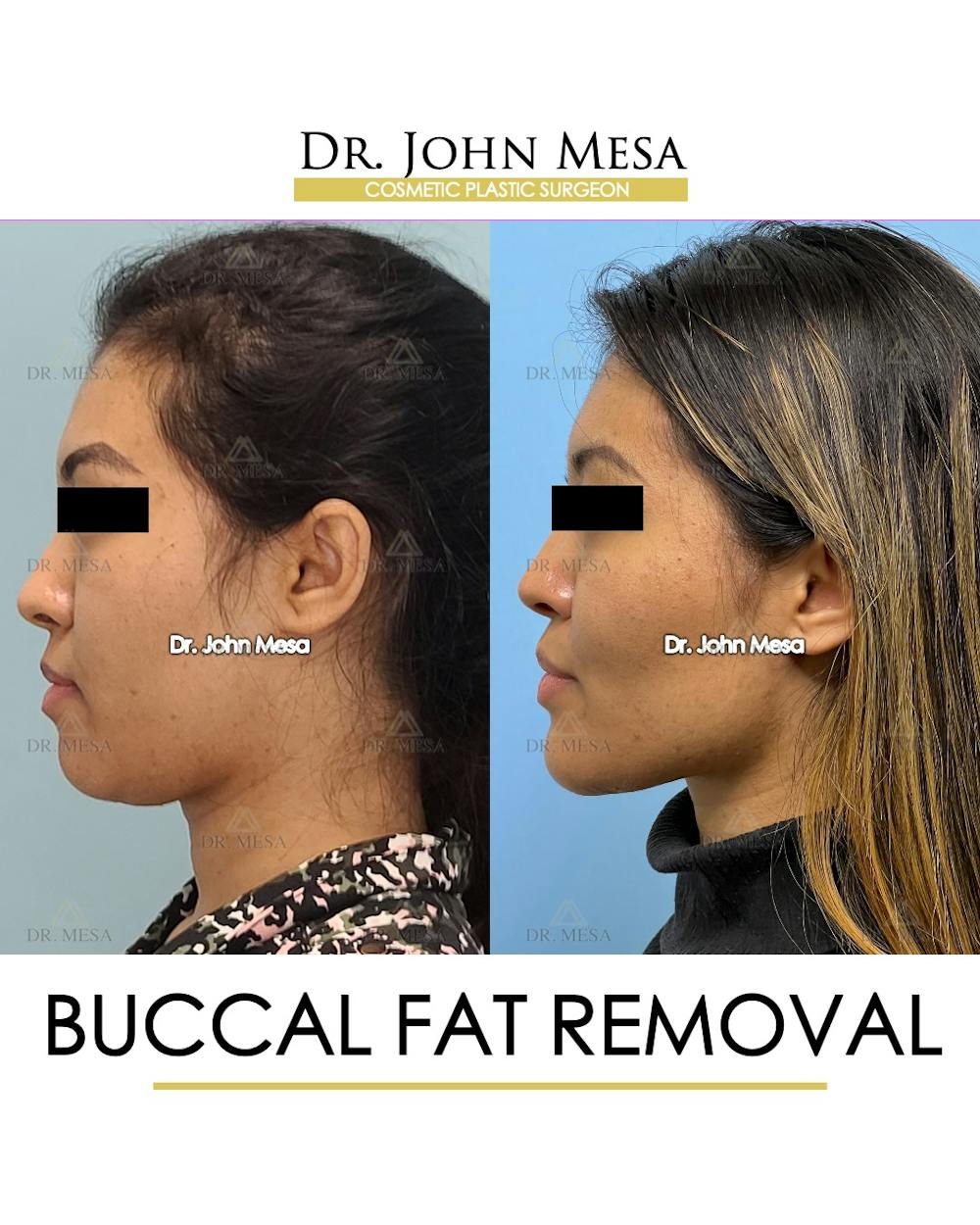 Buccal Fat Pad Removal Before & After Gallery - Patient 148316698 - Image 5