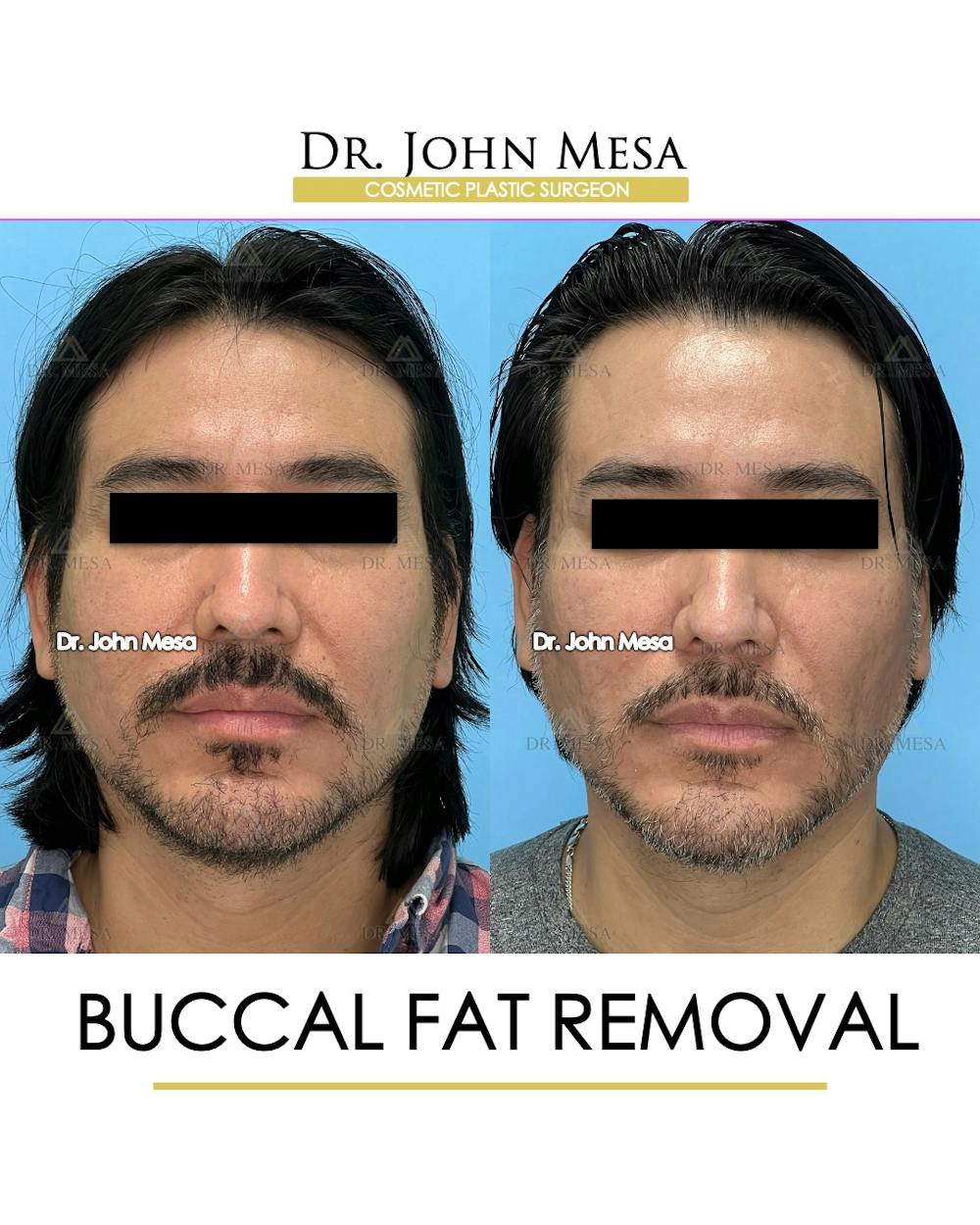 Buccal Fat Pad Removal for Men Before & After Gallery - Patient 148338377 - Image 1