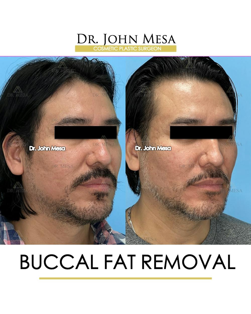 Buccal Fat Pad Removal for Men Before & After Gallery - Patient 148338377 - Image 2