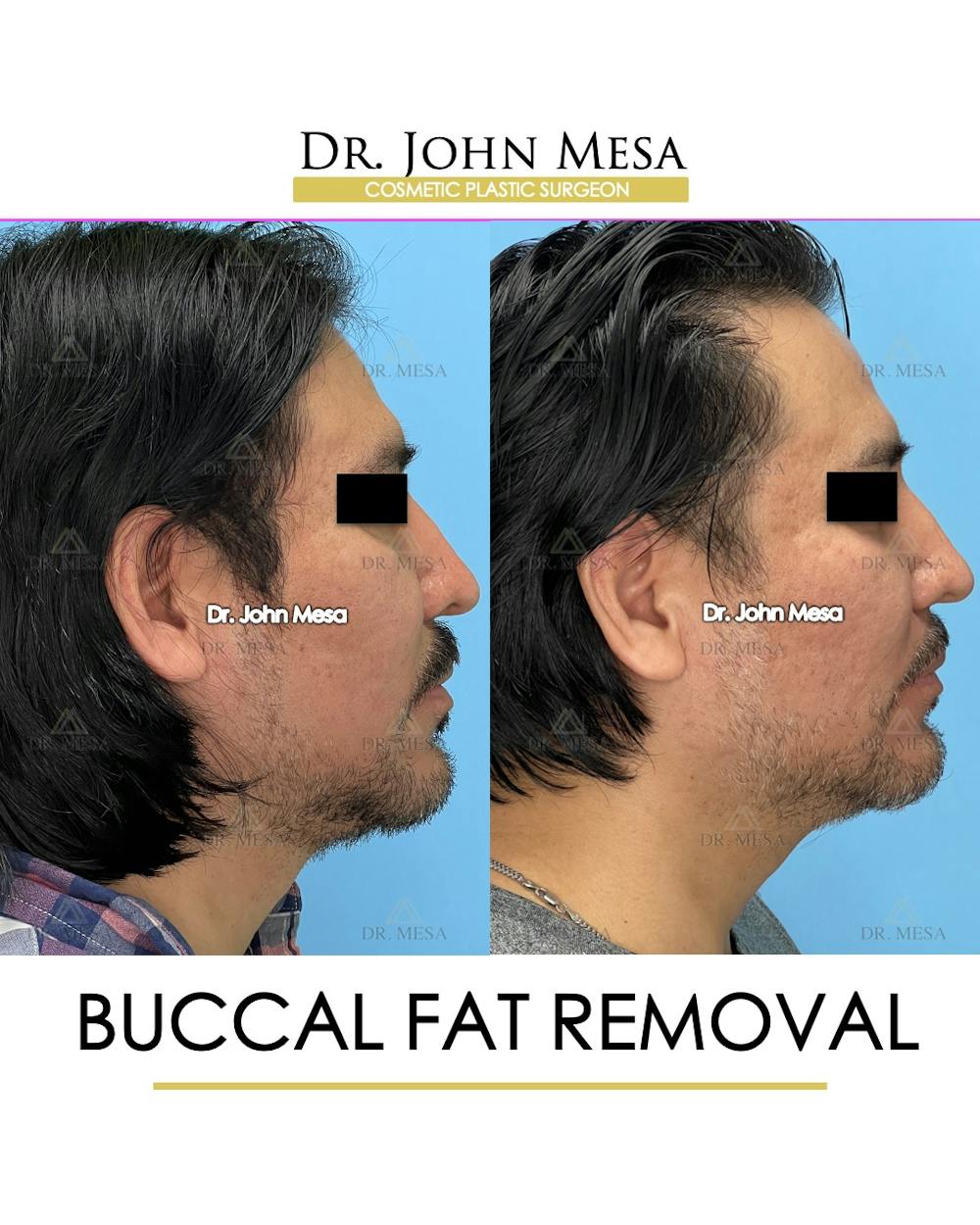 Buccal Fat Pad Removal for Men Before & After Gallery - Patient 148338377 - Image 3