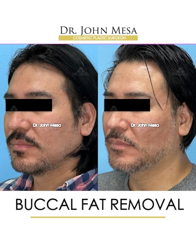 Buccal Fat Pad Removal for Men Before & After Gallery - Patient 148338377 - Image 4
