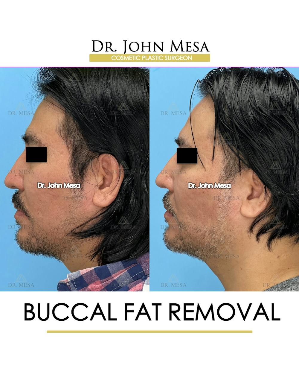 Buccal Fat Pad Removal for Men Before & After Gallery - Patient 148338377 - Image 5