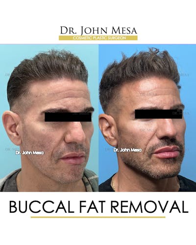 Buccal Fat Pad Removal for Men Before & After Gallery - Patient 148338378 - Image 2