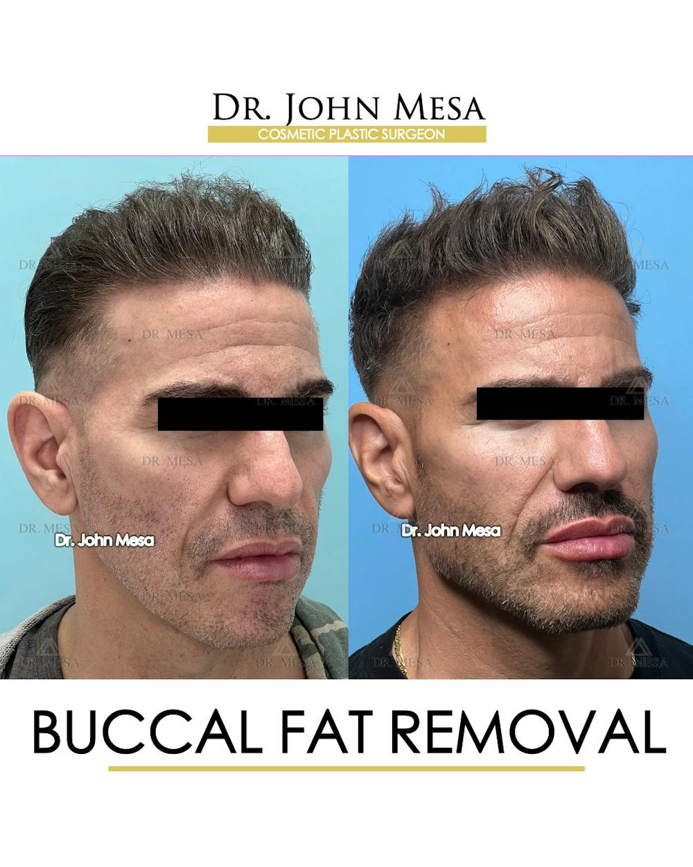 Buccal Fat Pad Removal for Men Before & After Gallery - Patient 148338378 - Image 2