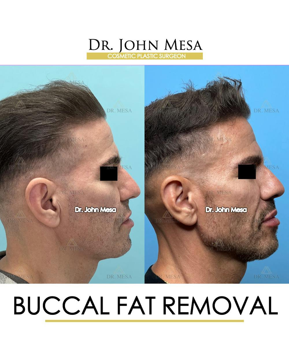 Buccal Fat Pad Removal for Men Before & After Gallery - Patient 148338378 - Image 3