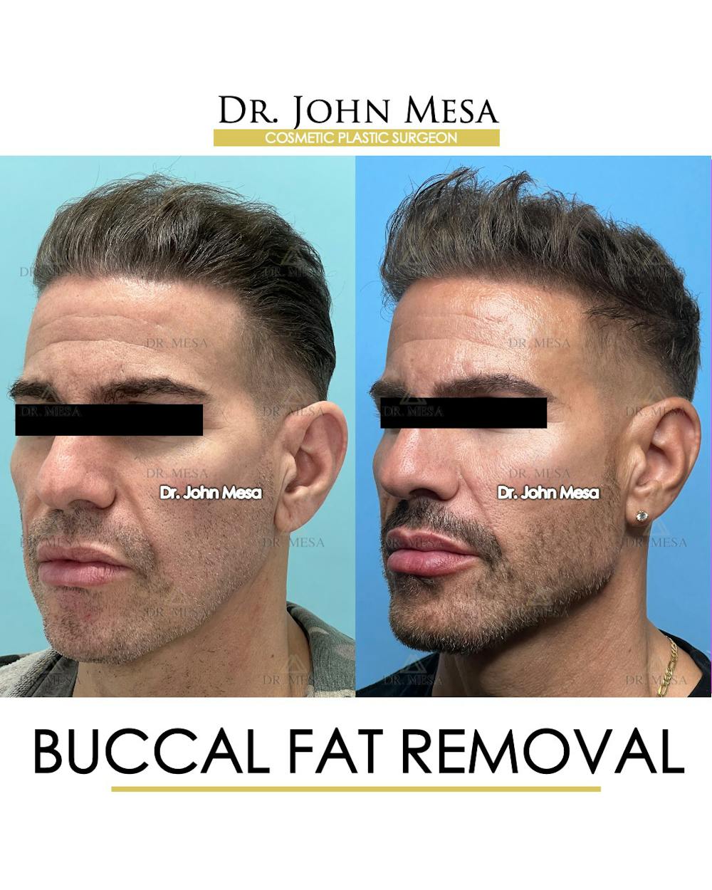 Buccal Fat Pad Removal for Men Before & After Gallery - Patient 148338378 - Image 4