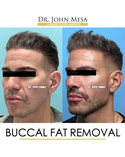 Buccal Fat Pad Removal for Men Before & After Gallery - Patient 148338378 - Image 4
