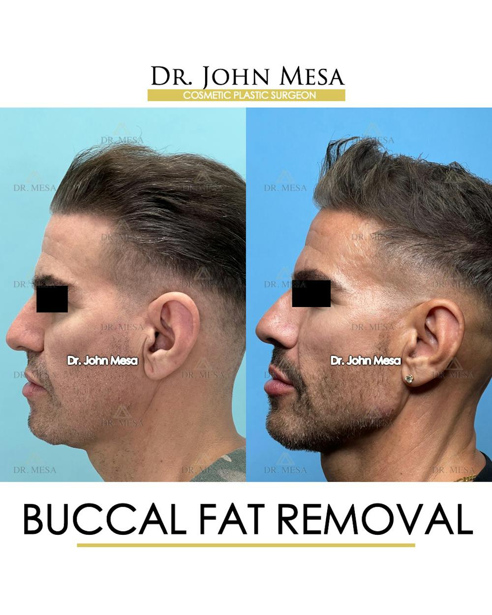 Buccal Fat Pad Removal for Men Before & After Gallery - Patient 148338378 - Image 5