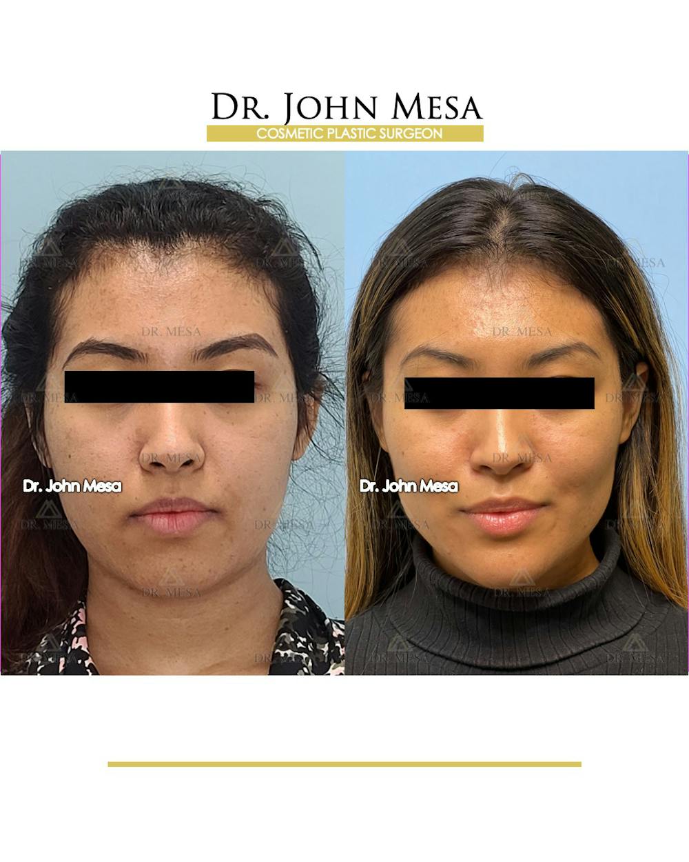 Chin Filler Before & After Gallery - Patient 148316719 - Image 1