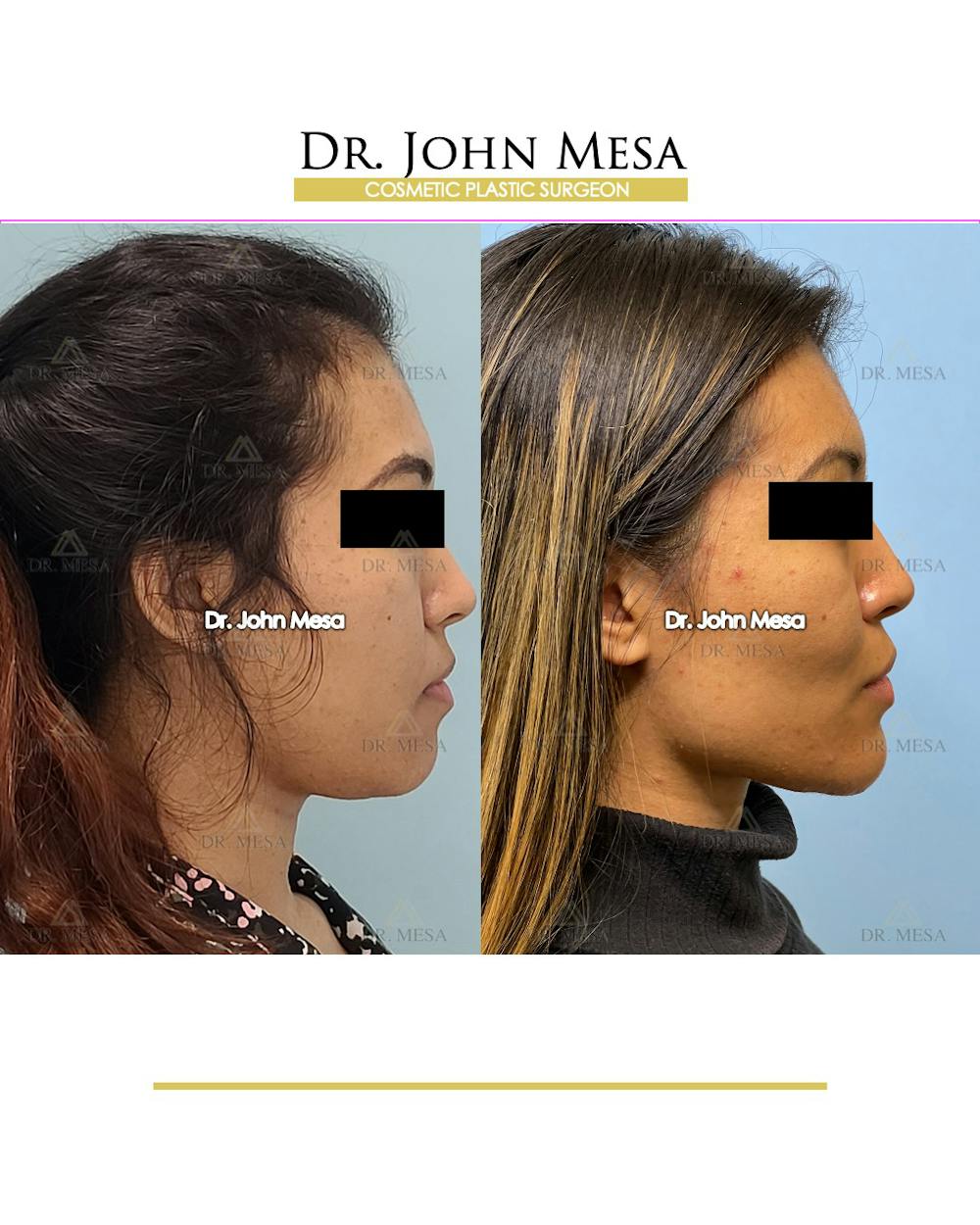 Chin Filler Before & After Gallery - Patient 148316719 - Image 3