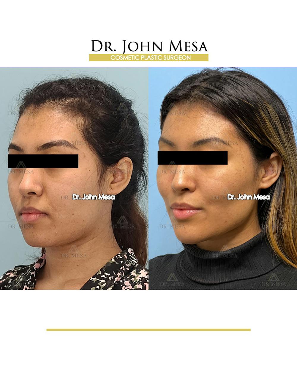 Chin Filler Before & After Gallery - Patient 148316719 - Image 4