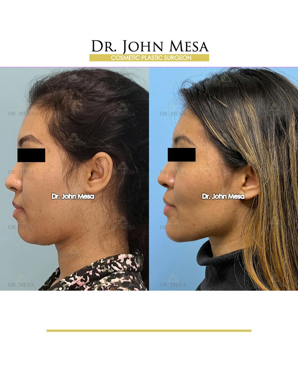 Cheekbone Filler Before & After Gallery - Patient 148316711 - Image 5