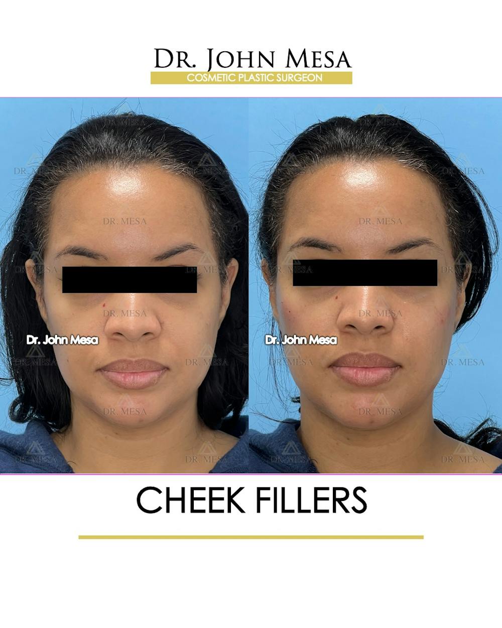 Cheekbone Filler Before & After Gallery - Patient 148316712 - Image 1
