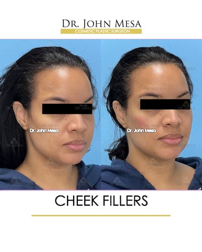 Cheekbone Filler Before & After Gallery - Patient 148316712 - Image 2