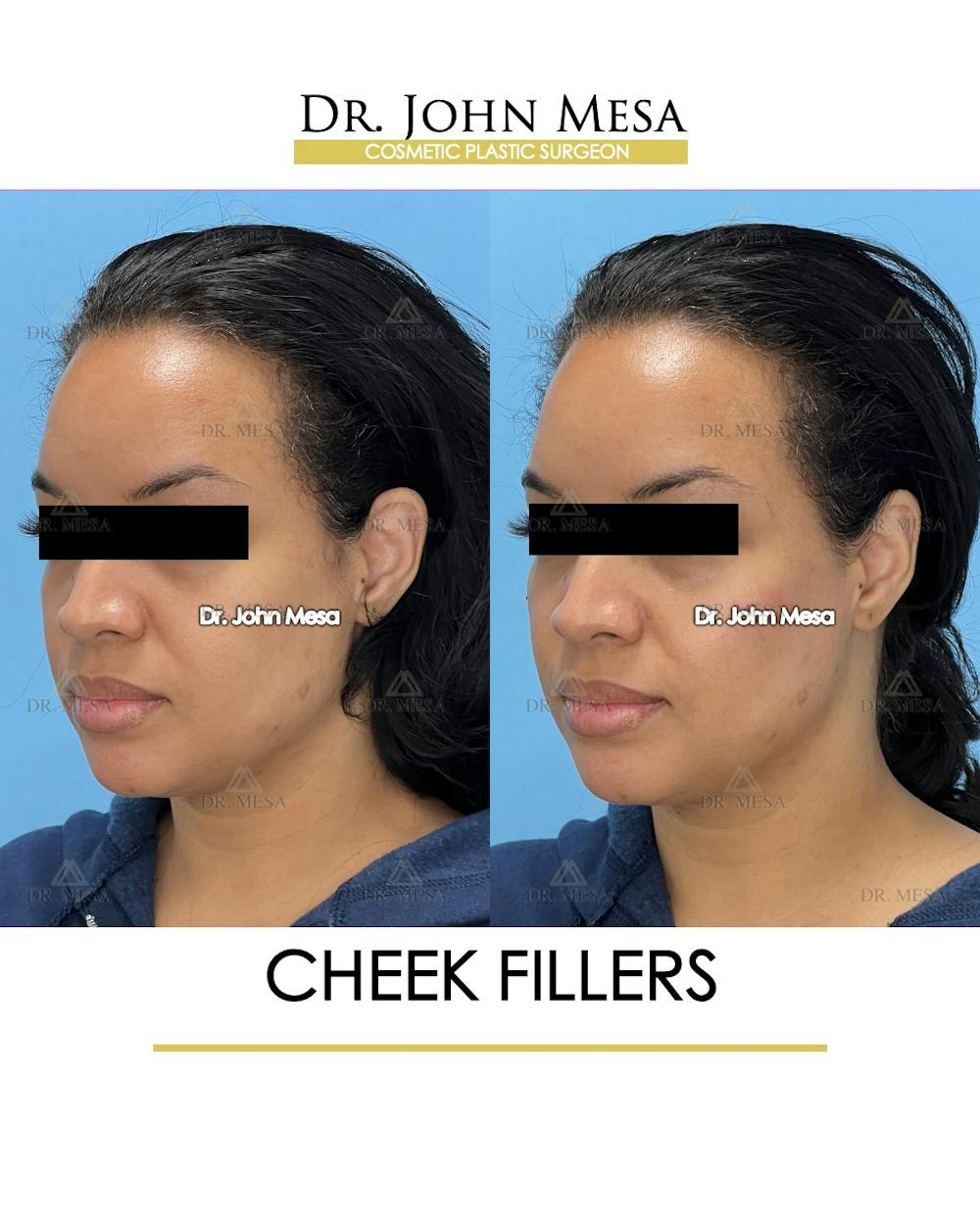 Cheekbone Filler Before & After Gallery - Patient 148316712 - Image 3