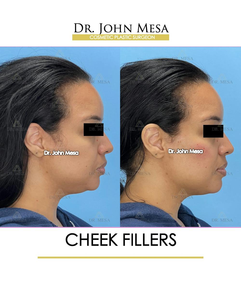 Cheekbone Filler Before & After Gallery - Patient 148316712 - Image 4