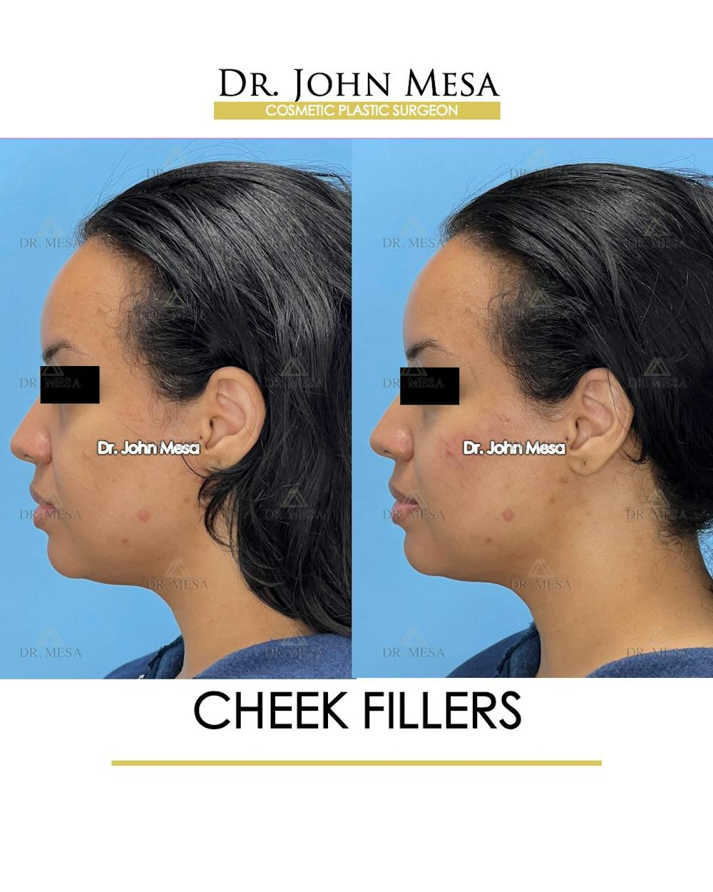 Cheekbone Filler Before & After Gallery - Patient 148316712 - Image 5