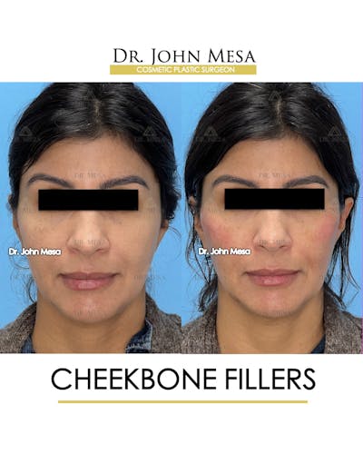 Cheekbone Filler Before & After Gallery - Patient 148316713 - Image 1