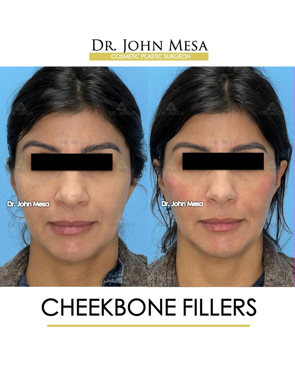 Cheekbone Filler Before & After Gallery - Patient 148316713 - Image 1