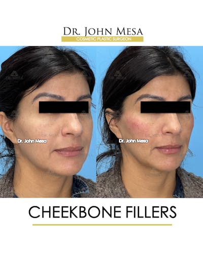 Cheekbone Filler Before & After Gallery - Patient 148316713 - Image 2