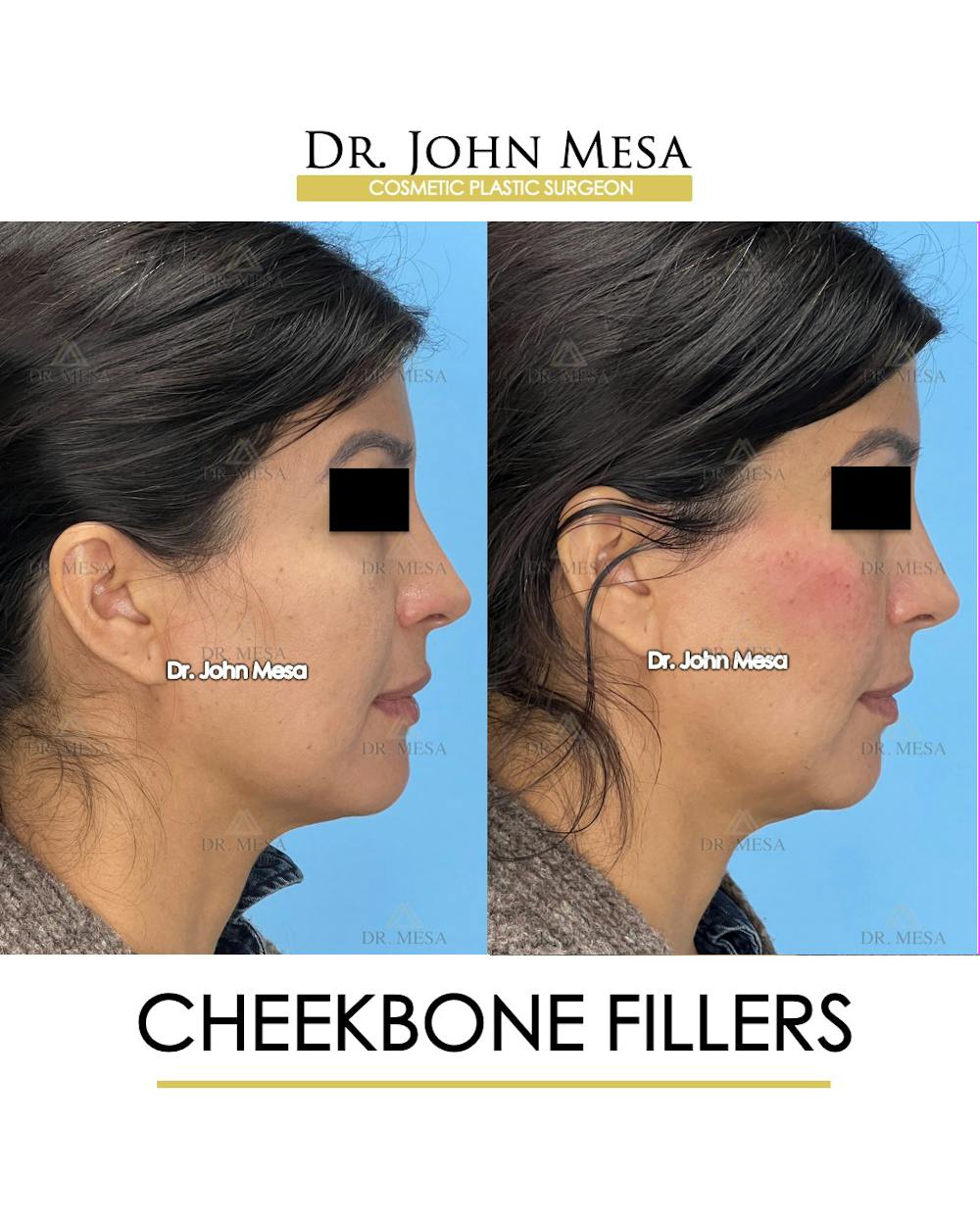 Cheekbone Filler Before & After Gallery - Patient 148316713 - Image 3