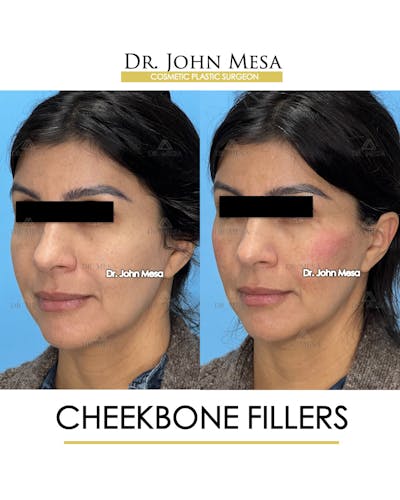 Cheekbone Filler Before & After Gallery - Patient 148316713 - Image 4