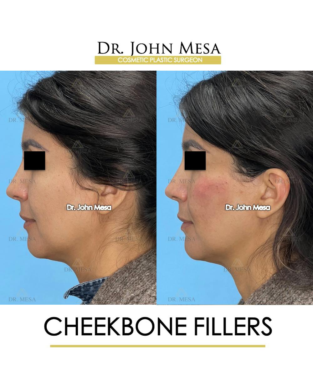 Cheekbone Filler Before & After Gallery - Patient 148316713 - Image 5