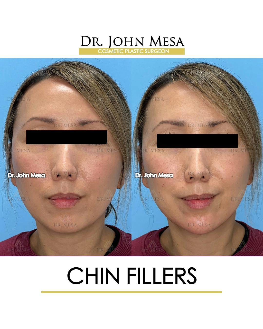Chin Filler Before & After Gallery - Patient 148316721 - Image 1