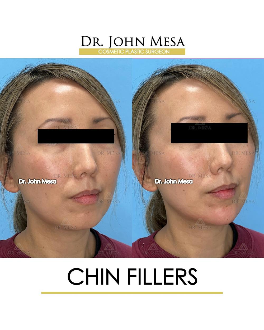 Chin Filler Before & After Gallery - Patient 148316721 - Image 2