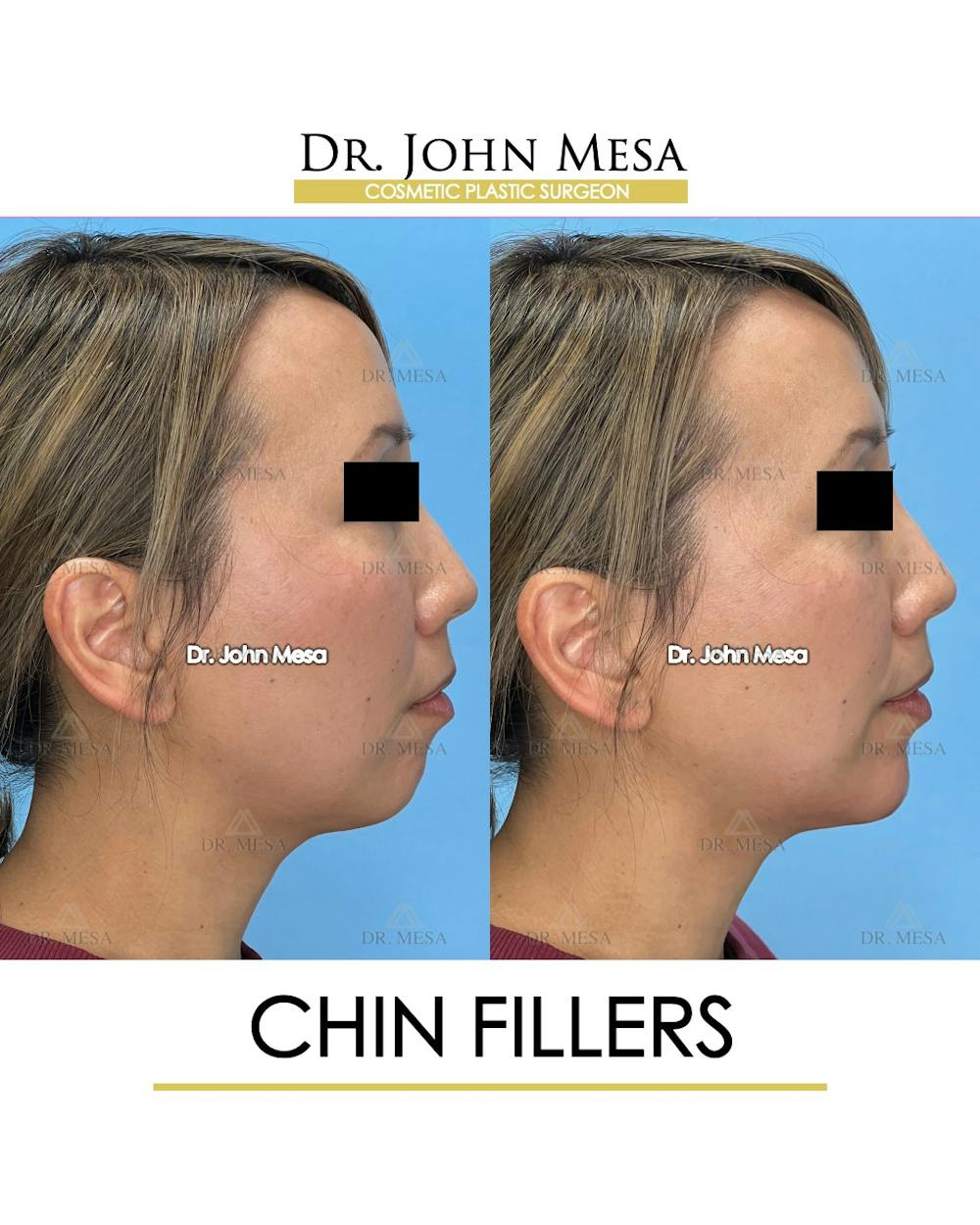 Chin Filler Before & After Gallery - Patient 148316721 - Image 3