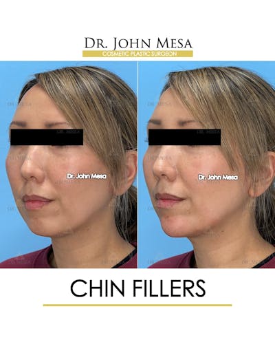 Chin Filler Before & After Gallery - Patient 148316721 - Image 4