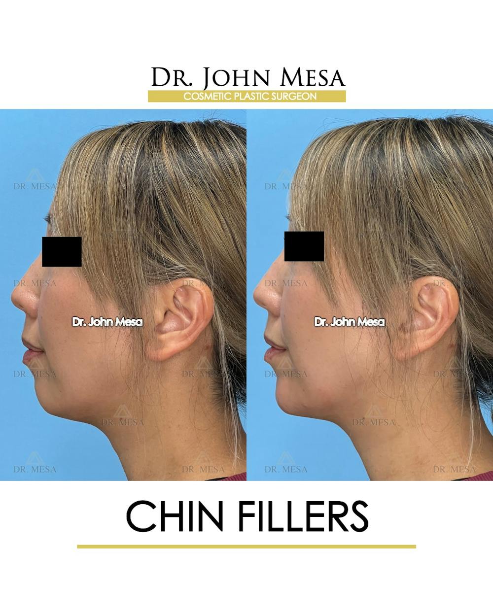 Chin Filler Before & After Gallery - Patient 148316721 - Image 5