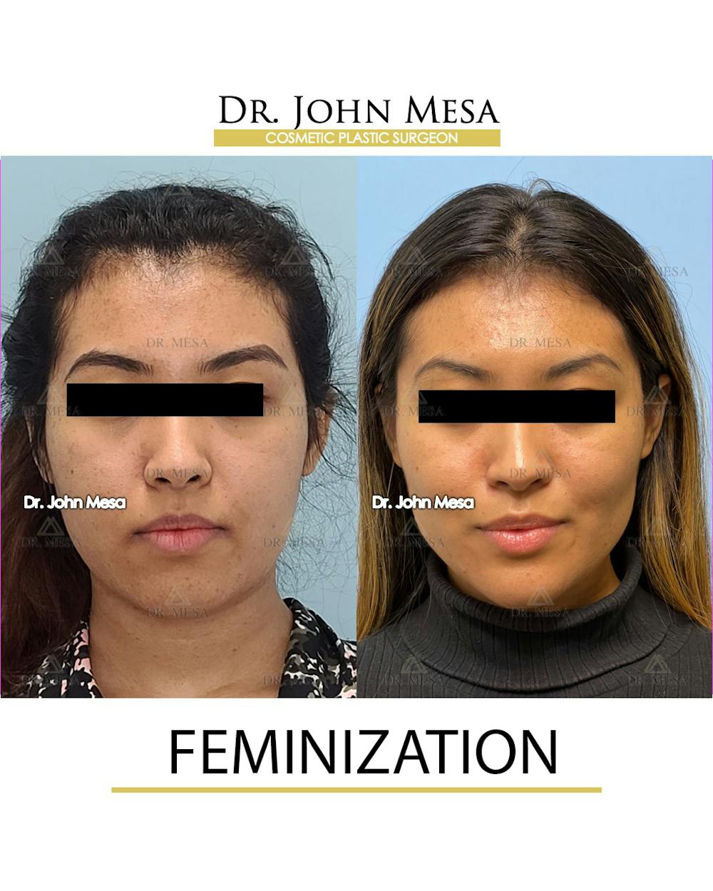 Facial Feminization Before & After Gallery - Patient 148316724 - Image 1