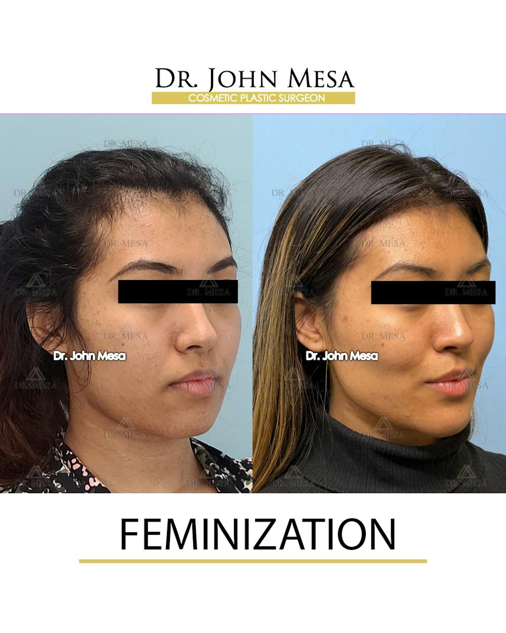 Facial Feminization Before & After Gallery - Patient 148316724 - Image 2