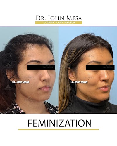 Facial Feminization Before & After Gallery - Patient 148316724 - Image 2