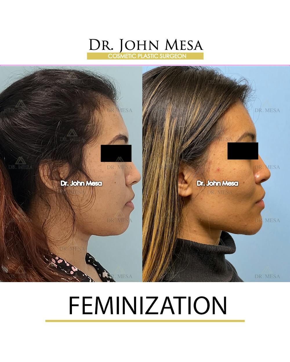 Facial Feminization Before & After Gallery - Patient 148316724 - Image 3
